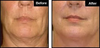 Cellulite Treatment Before And After