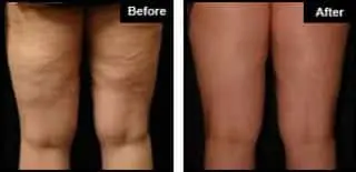 London Cellulite Treatment Example