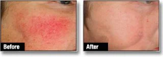 Rosacea Treatment London Before and After