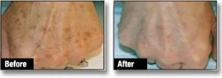 Sunspots and Age Spots Treatment Example
