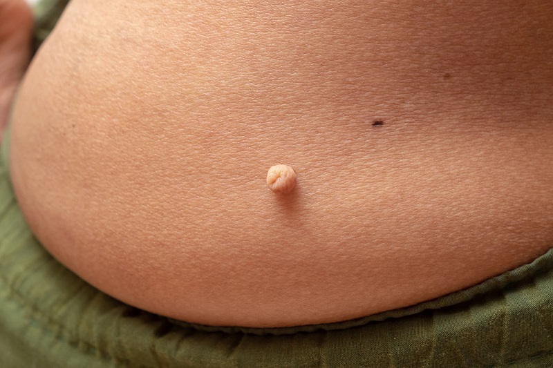 What are skin tags